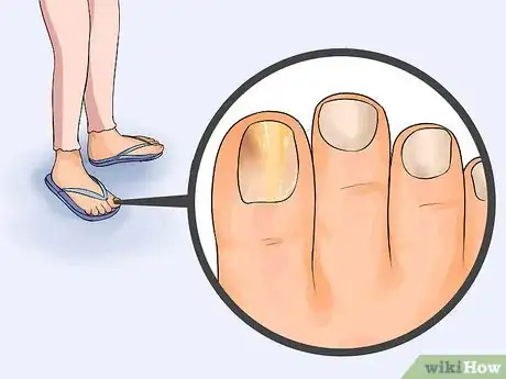 Imagen titulada Get Rid of Toe Fungus Step 1