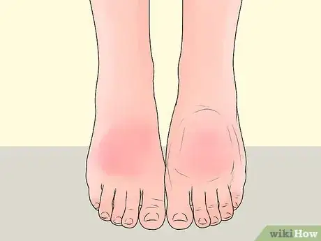 Imagen titulada Check Feet for Complications of Diabetes Step 7