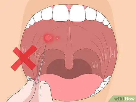 Imagen titulada Get Rid of Mouth Blisters Step 16