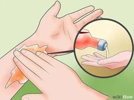 Imagen titulada Treat Skin Rash Step 11