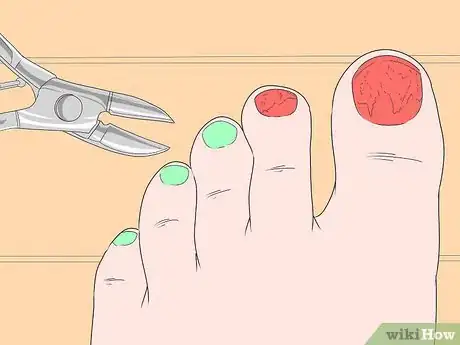 Imagen titulada Trim Toenails with Fungus Step 6