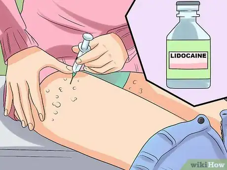 Imagen titulada Ease Herpes Pain with Home Remedies Step 21