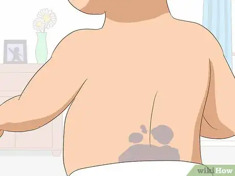 Imagen titulada Remove Birthmarks Step 14