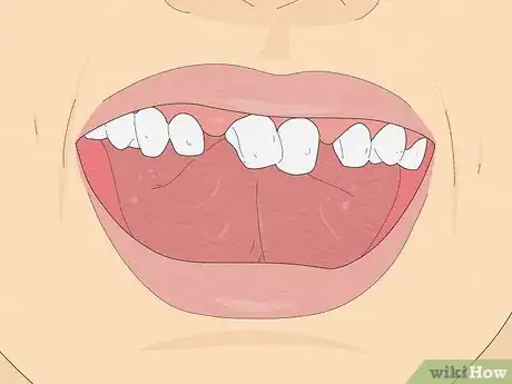 Imagen titulada Pull a Loose Tooth at Home Step 6