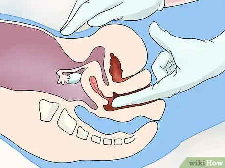 Imagen titulada Diagnose Uterine Fibroids Step 5