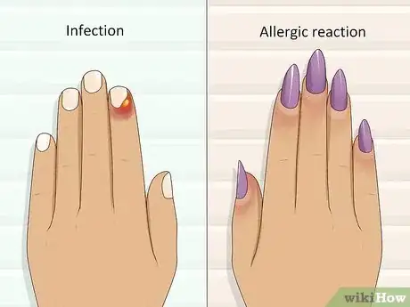 Imagen titulada Stop Itchy Cuticles Step 4