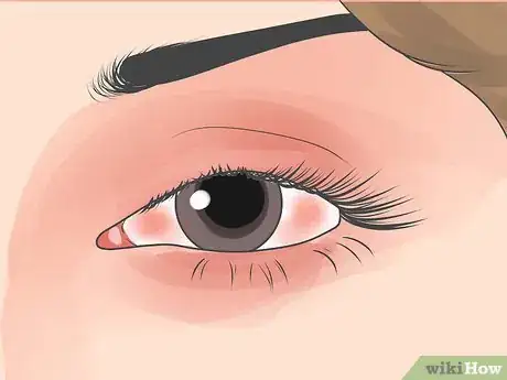 Imagen titulada Stop Your Eye or Eyebrow from Jumping Step 12