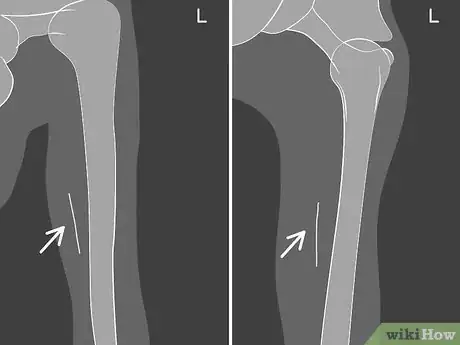 Imagen titulada Remove Nexplanon Step 6