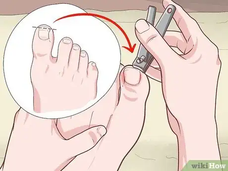 Imagen titulada Cut an Ingrown Toenail Step 4