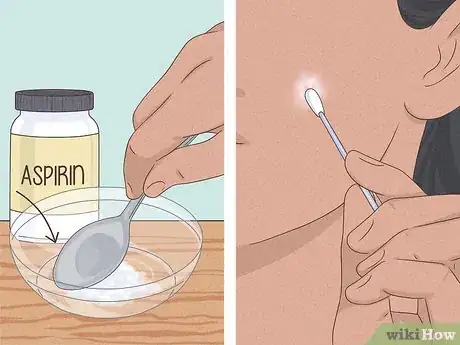 Imagen titulada Get Rid of a Zit Overnight Step 5