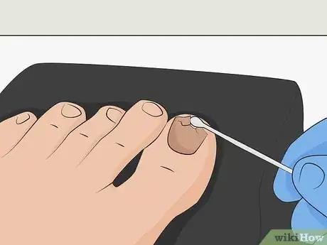 Imagen titulada Heal a Bruised Toenail Quickly Step 14