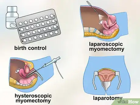 Imagen titulada Diagnose Uterine Fibroids Step 7