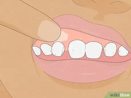 Imagen titulada Pull a Loose Tooth at Home Step 7