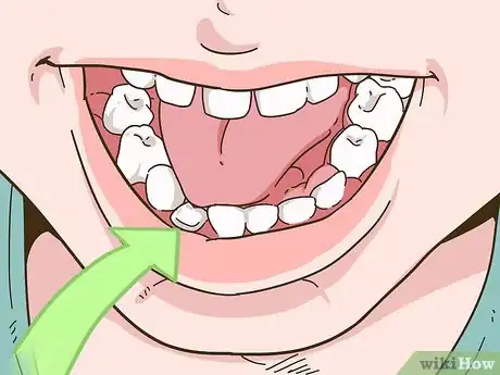 Imagen titulada Painlessly Pull Out a Loose Baby Tooth Step 2