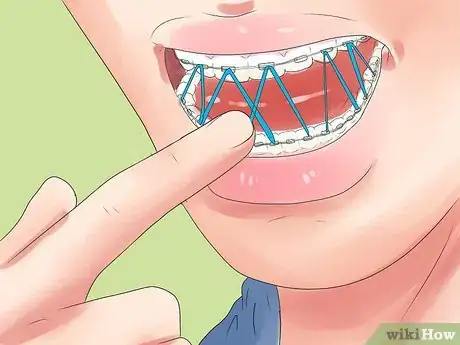 Imagen titulada Alleviate Orthodontic Brace Pain Step 11