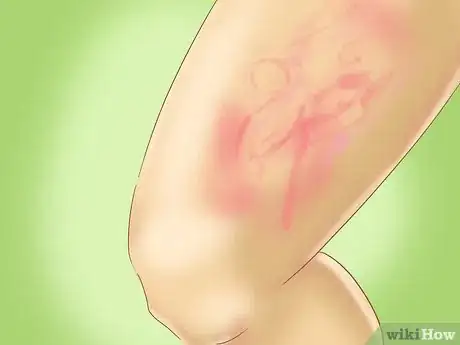 Imagen titulada Recognize Hives (Urticaria) Step 1