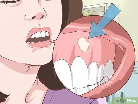 Imagen titulada Relieve Gum Pain Step 1