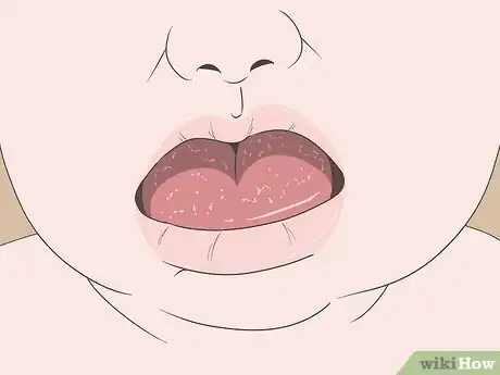 Imagen titulada Know if You Have Oral Thrush Step 4