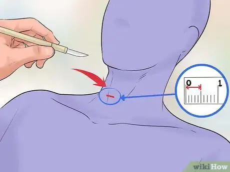 Imagen titulada Perform a Tracheotomy Step 10