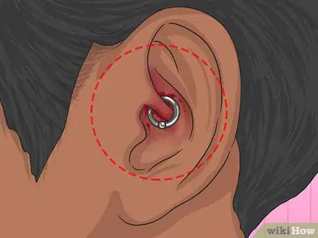 Imagen titulada Clean a Daith Piercing Step 11