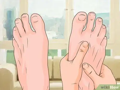 Imagen titulada Treat Bunions Naturally Step 8