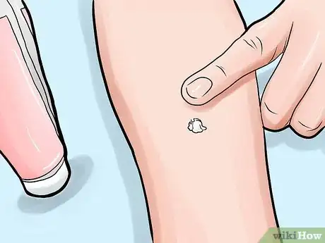 Imagen titulada Heal Mosquito Bites Step 3