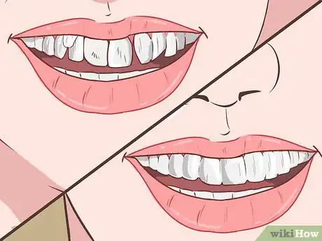 Imagen titulada Straighten Your Teeth Without Braces Step 6