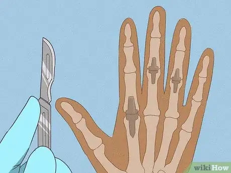 Imagen titulada Get Rid of Arthritis Bumps on Fingers Step 12