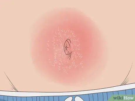 Imagen titulada Treat an Infection in Your Belly Button Step 2