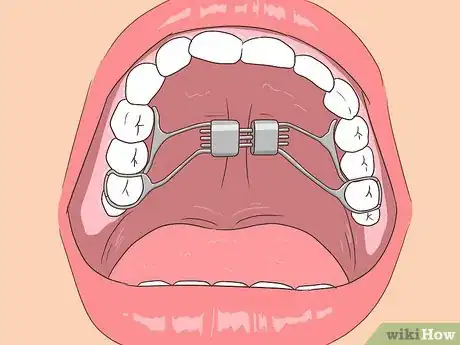 Imagen titulada Fix an Underbite Step 3