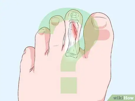 Imagen titulada Bandage Fingers or Toes Step 6