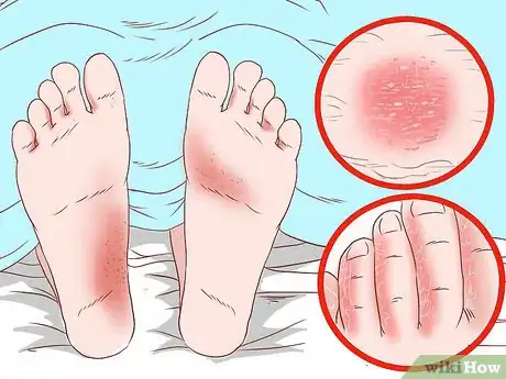 Imagen titulada Prevent Skin Fungus Step 8
