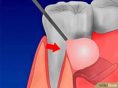 Imagen titulada Get Rid of Gingivitis Step 4Bullet4