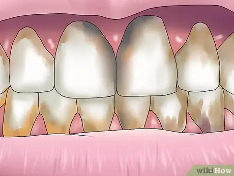 Imagen titulada Reverse Dental Bone Loss Step 13