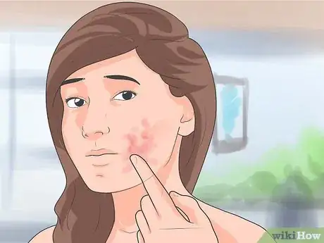 Imagen titulada Get Rid of Hives on the Face Step 10