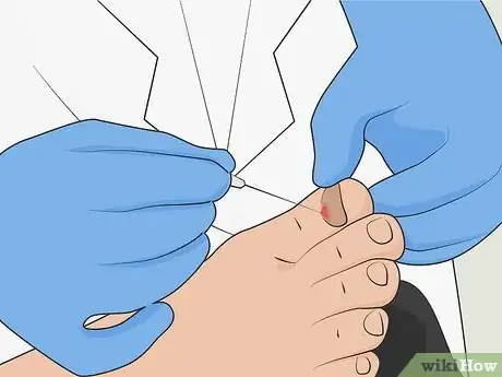 Imagen titulada Heal a Bruised Toenail Quickly Step 13