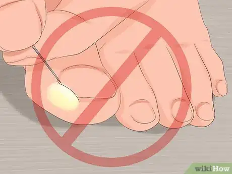 Imagen titulada Remove Infection from an Ingrown Toenail Step 7