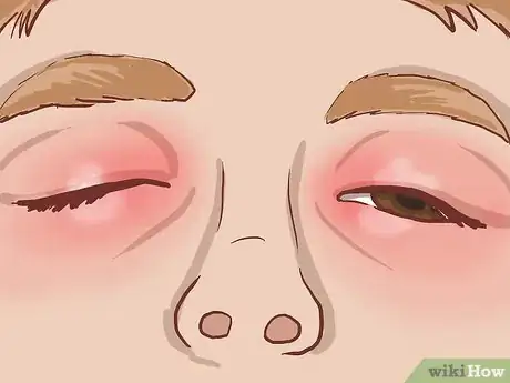 Imagen titulada Treat Eczema Around the Eyes Step 5