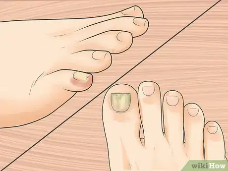 Imagen titulada Tell if You Have an Ingrown Toenail Step 4