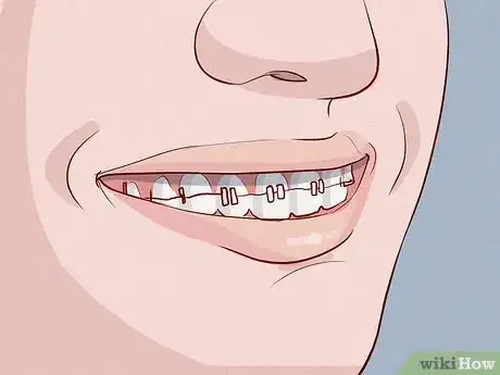 Imagen titulada Smile when You Think You Have Bad Teeth Step 8