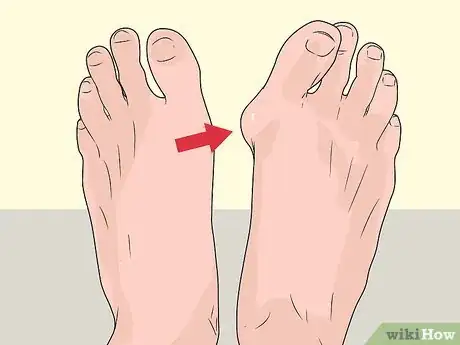 Imagen titulada Check Feet for Complications of Diabetes Step 6