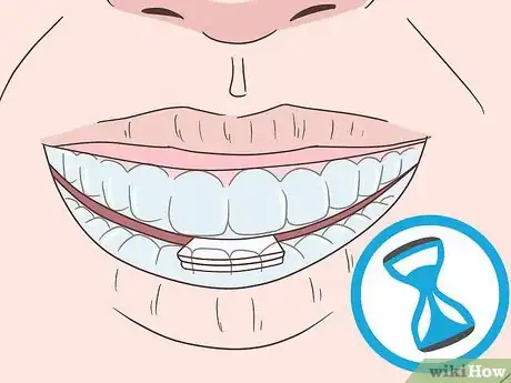 Imagen titulada Cope with Teeth Whitening Sensitivity Step 7