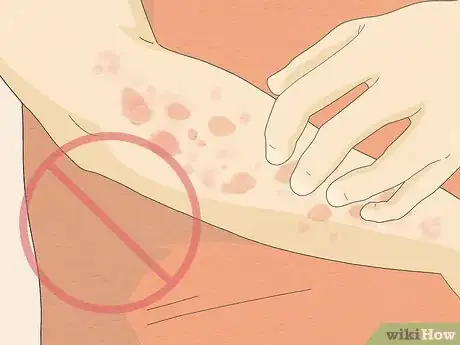 Imagen titulada Recognize Hives (Rash) Step 14