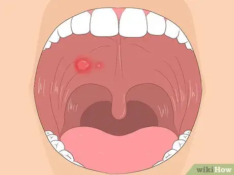 Imagen titulada Get Rid of Mouth Blisters Step 13