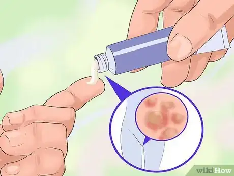 Imagen titulada Treat Genital Warts in Women Step 5