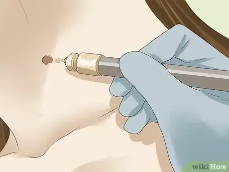 Imagen titulada Get Rid of Skin Tags Step 4