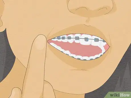 Imagen titulada Temporarily Fix a Loose Wire on Your Braces Step 1