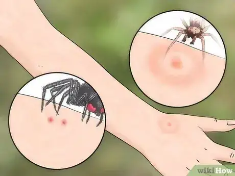 Imagen titulada Identify Insect Bites Step 7