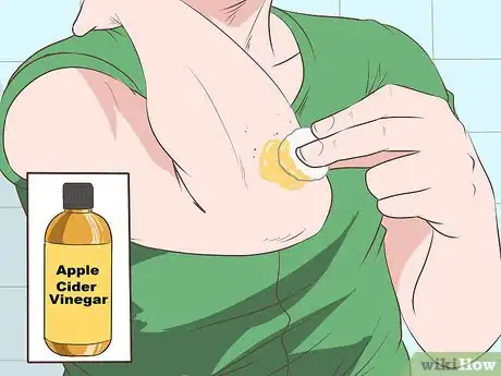 Imagen titulada Stop Mosquito Bites from Itching Step 5