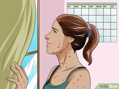 Imagen titulada Prevent Chickenpox Step 5